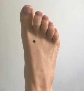 acupressure for hidradenitis suppurative foot image