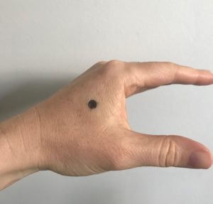 acupressure for hidradenitis suppurativa hand