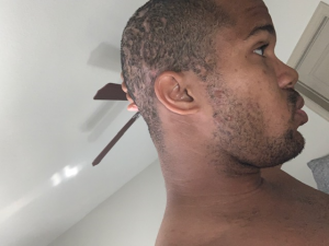 Ronnie hidradentis suppurativa head sacrs