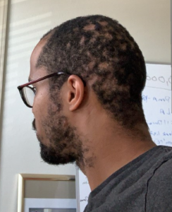 Ronnie hidradenitis suppurativa breakout head