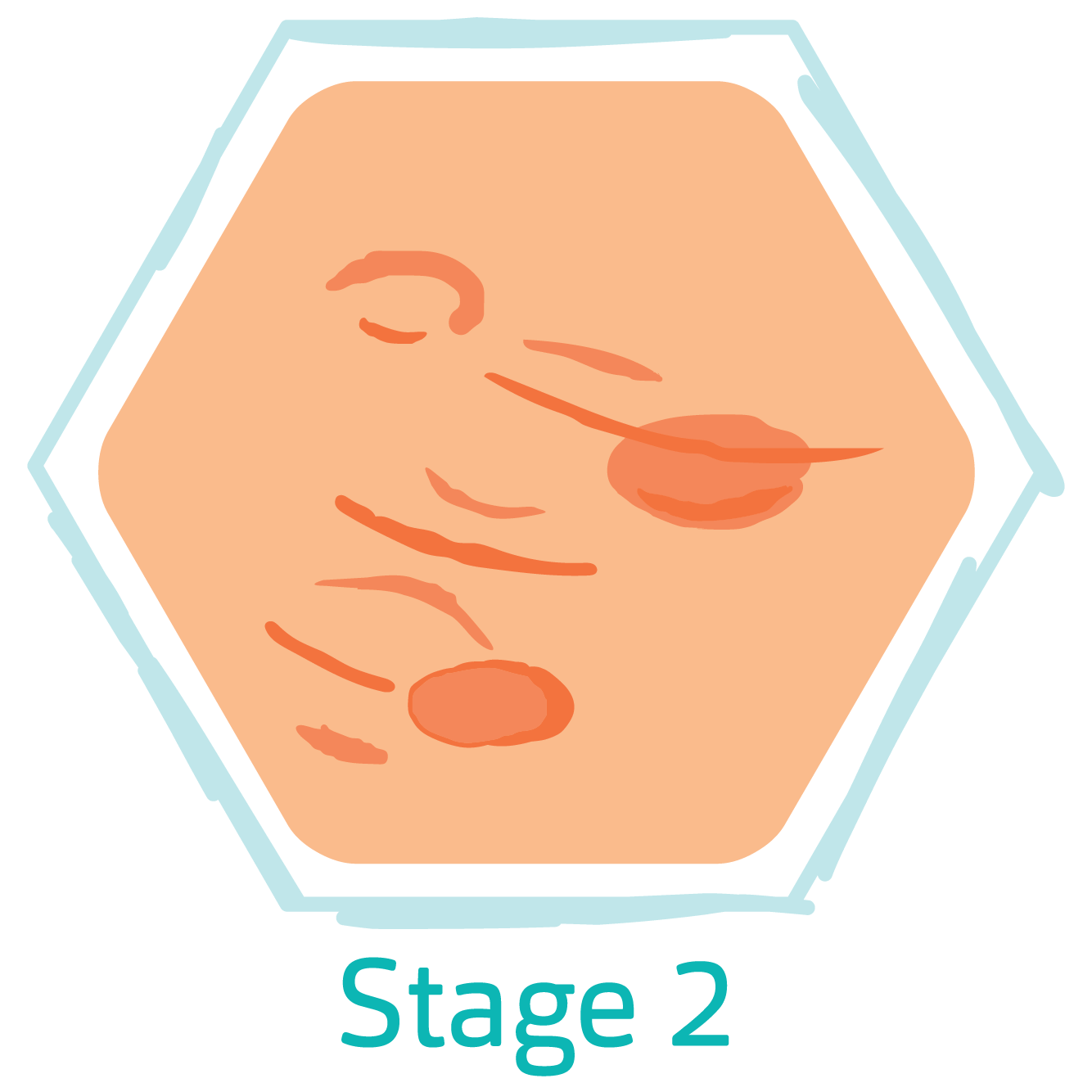 hidradenitis suppurativa stage 2