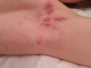 hidradenitis suppurativa stage 2 lesions, scarring and tunnelling