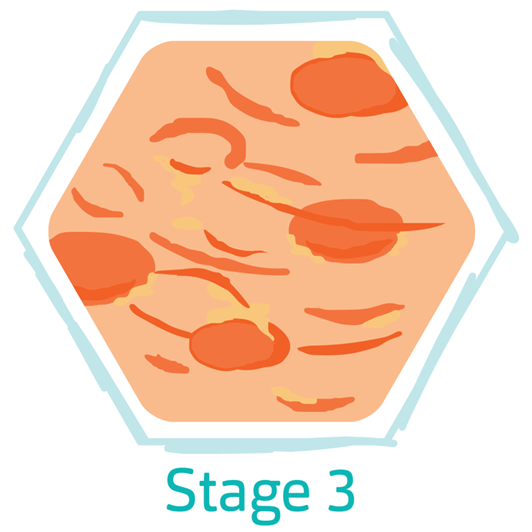 Hidradenitis Suppurativa Stage 3