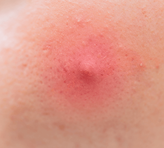 Follicular occlusion