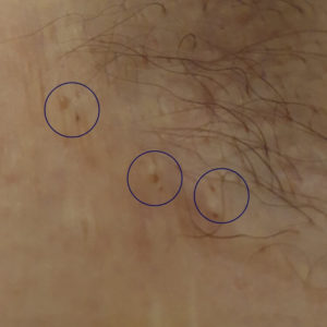 Double headed blackheads