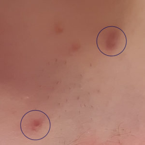 Small lumps under the skin