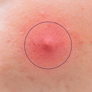 Follicular occlusion