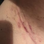 hidradenitis suppurativa armpit