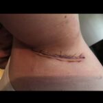 hidradenitis suppurativa surgery